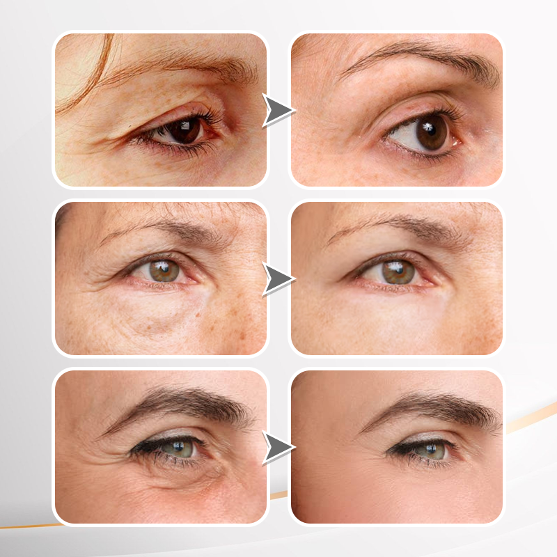 🔥 Last Day Discount: 87% OFF💐Instant Wrinkle Eye Tightener cream