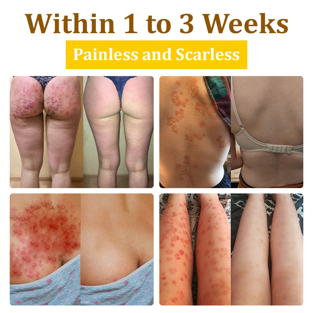 🌿NESLEMY™ 20% Salicylic Acid Skin Treatment Cream ✔️ Dermatologist-Approved ✔️ Safe & Fast-Acting Formula✔️ Helps with Warts, Psoriasis, Eczema, and More