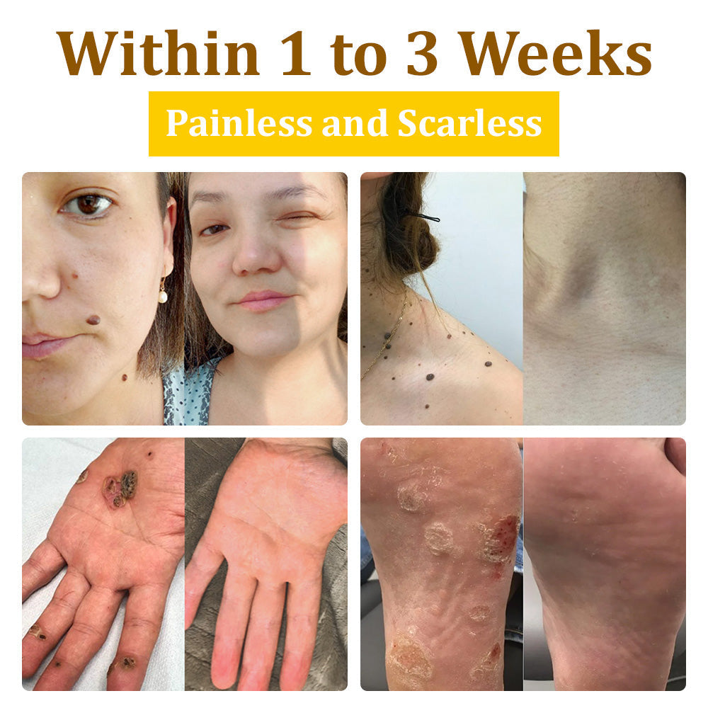🌿NESLEMY™ 20% Salicylic Acid Skin Treatment Cream ✔️ Dermatologist-Approved ✔️ Safe & Fast-Acting Formula✔️ Helps with Warts, Psoriasis, Eczema, and More