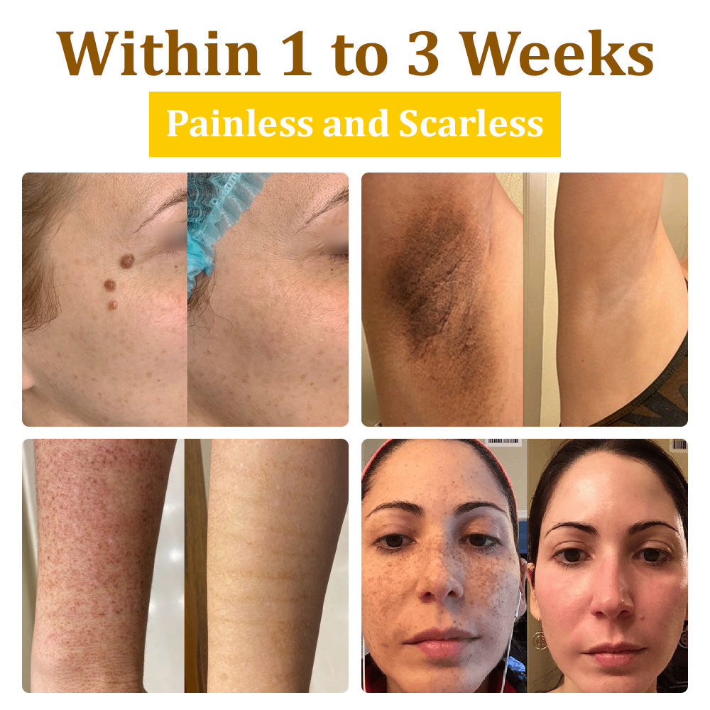 🌿NESLEMY™ 20% Salicylic Acid Skin Treatment Cream ✔️ Dermatologist-Approved ✔️ Safe & Fast-Acting Formula✔️ Helps with Warts, Psoriasis, Eczema, and More