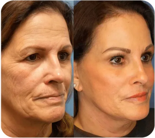 Last Day Discount: 87% OFF 🌸Instant face Tightener No-Filter Primer(Limited Time Discount)