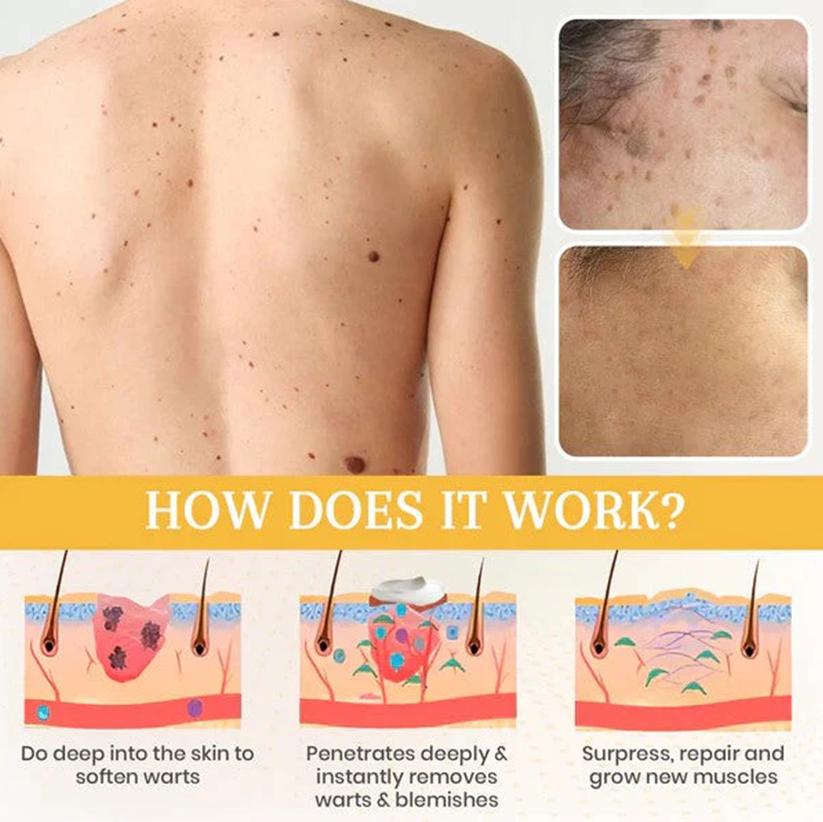 Derma Erase Advanced Mole & Spot Removal Gel