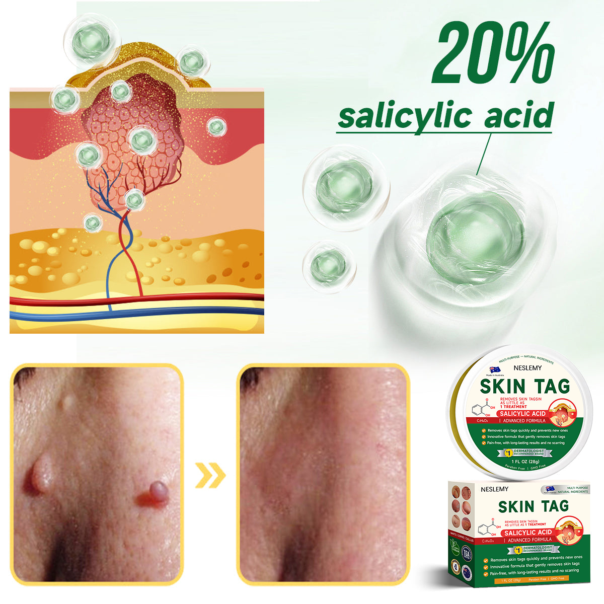 🌿NESLEMY™ 20% Salicylic Acid Skin Treatment Cream ✔️ Dermatologist-Approved ✔️ Safe & Fast-Acting Formula✔️ Helps with Warts, Psoriasis, Eczema, and More