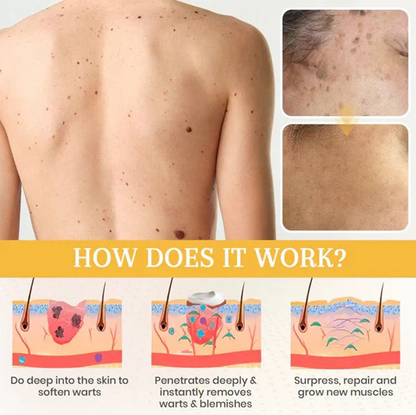 Derma Erase Advanced Mole & Spot Removal Gel